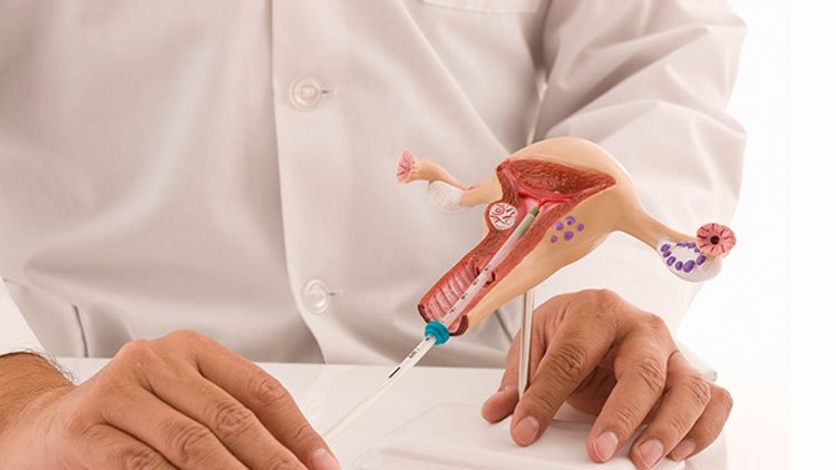Intrauterine contraceptive device removal