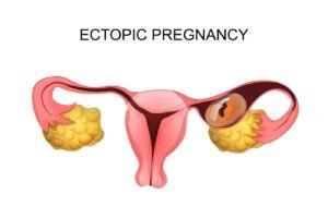 Read more about the article ALL ABOUT ECTOPIC PREGNANCY