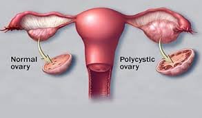 Long-term health problems of PCOD