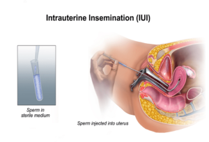 Read more about the article IUI Treatment For Couples And HowSuccessful Is It?