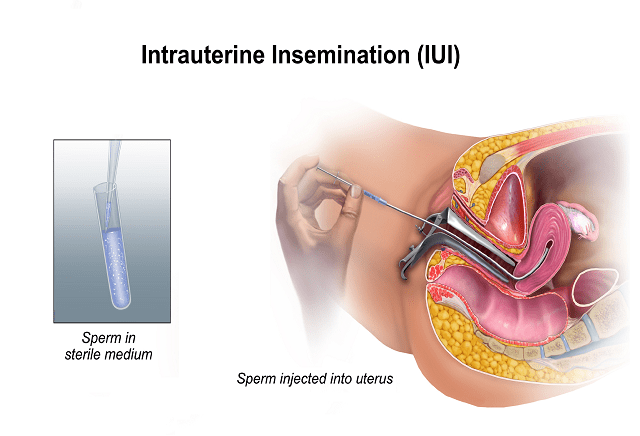 IUI Treatment For Couples And HowSuccessful Is It?