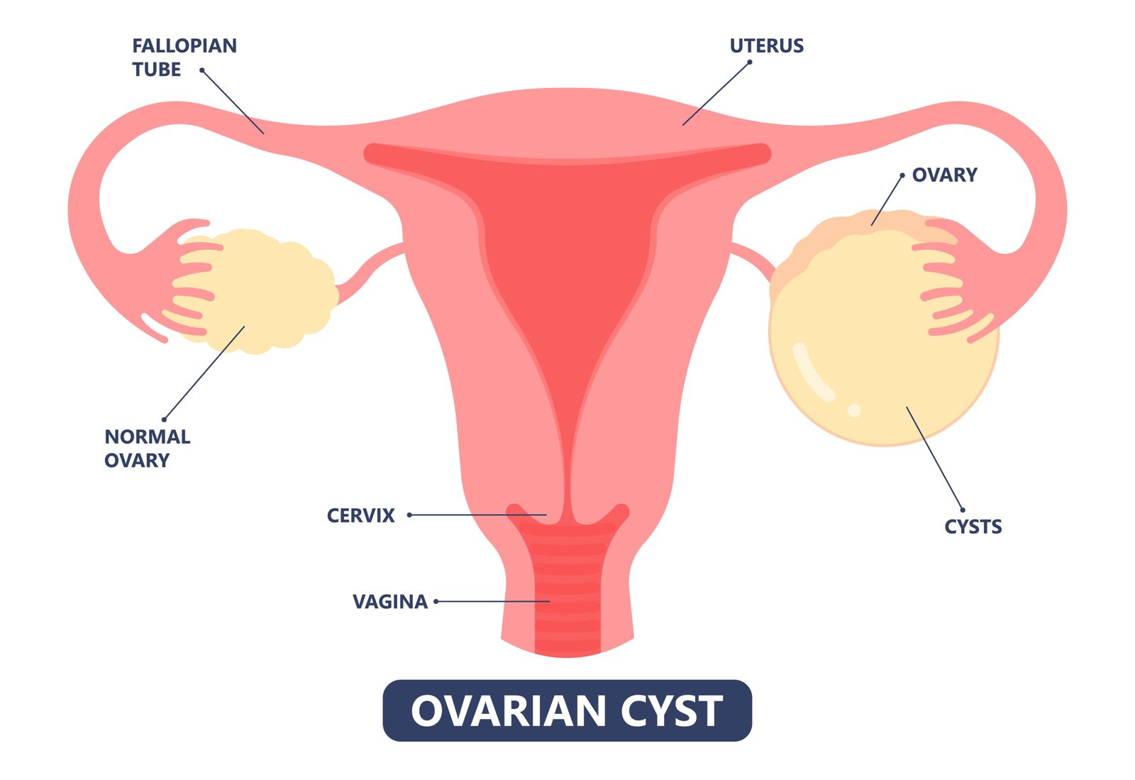 You are currently viewing What Are Ovarian Cysts? Can AnOvarian Cyst Can Be Normal?